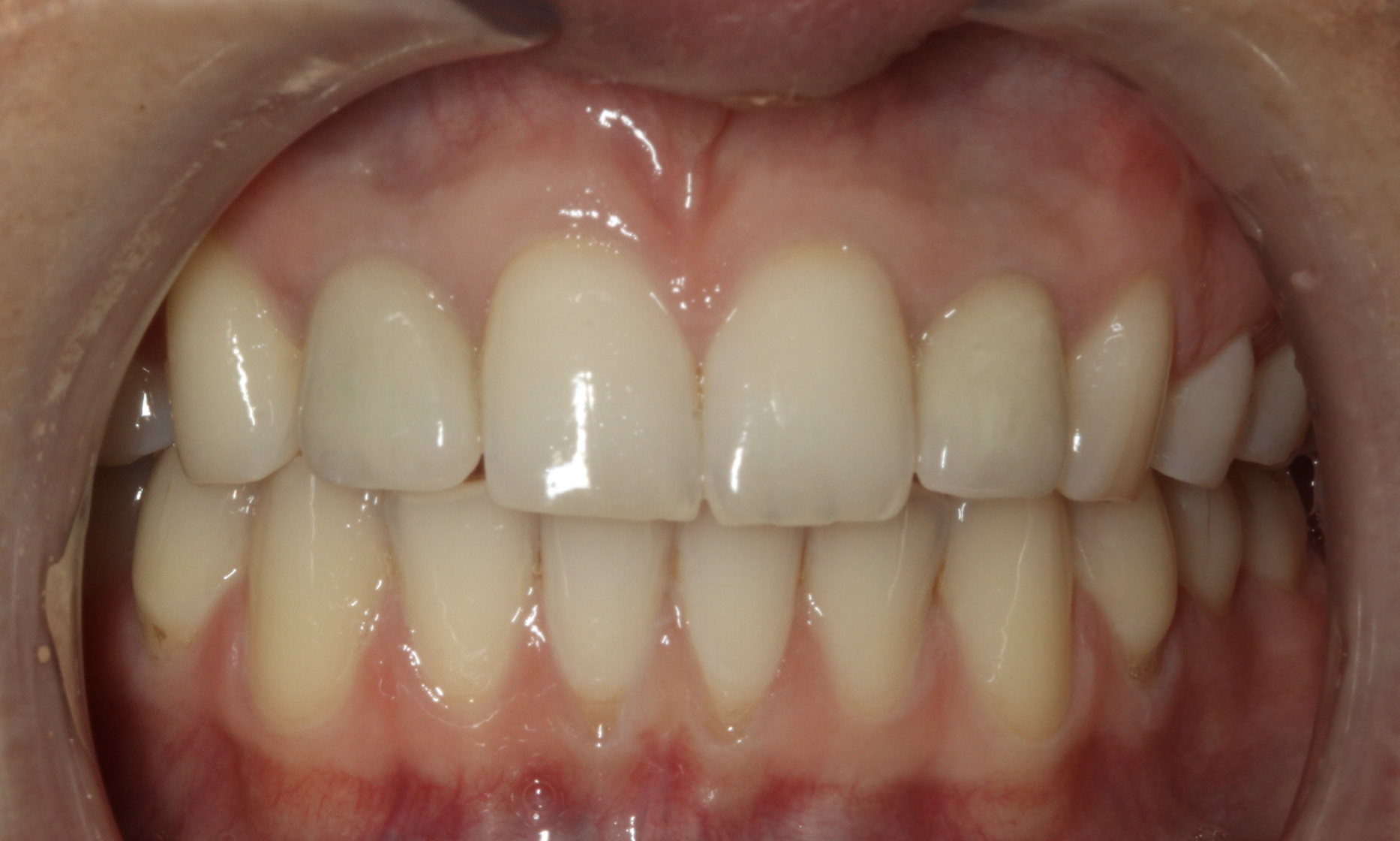 Dental Implants in Nottingham The Campbell Clinic